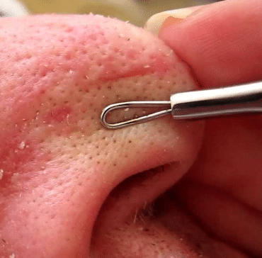 how to remove blackheads from nose - extractor