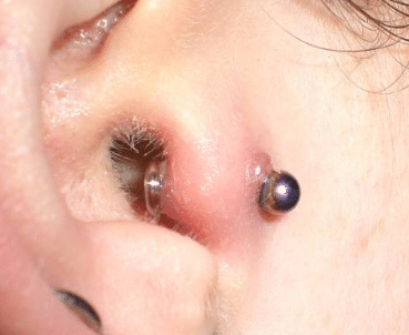 infected tragus piercing