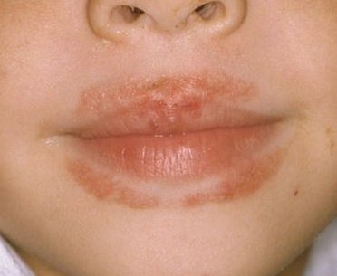 Rash  with reference to Mouth, Lips, Itchy, Dry Skin, Nose, Causes  