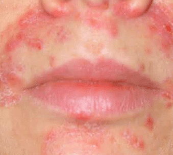 pimple acne around mouth