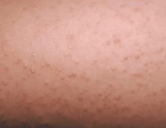 small white bumps on body