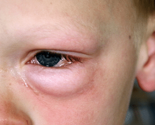 swelling under eye with redness