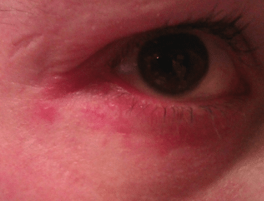 swollen lower eyelid
