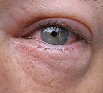 swollen under eye with pain