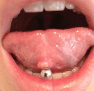 under tongue piercing infection