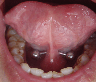 under tongue piercing healing