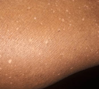 white bumps after sun tanning