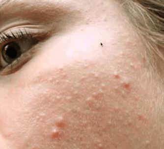 white bumps on skin face