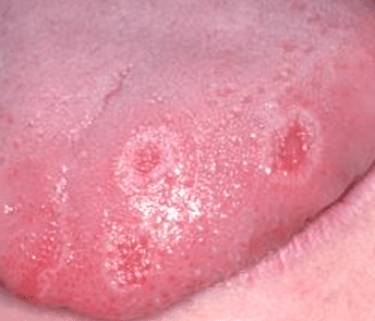 canker sores on tongue