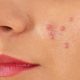 cropped woman with hard pimples on her face