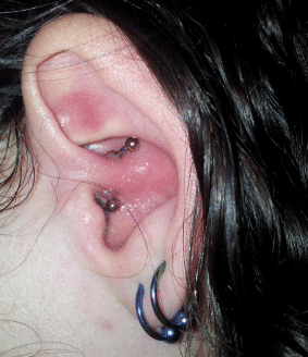infected daith piercing