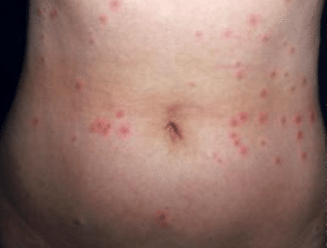 red spots on body