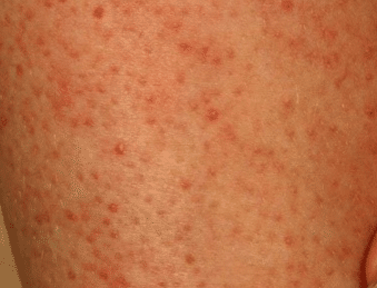 small red spots on body