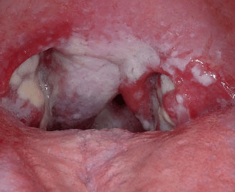 sores on back of tongue
