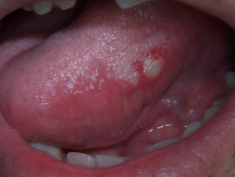 sores on tongue sides