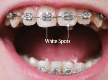 white spots on teeth after braces