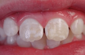 white stains on teeth