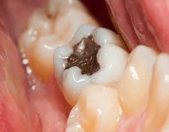 big hole in tooth