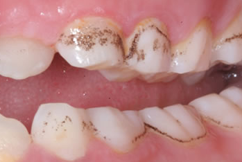brown stains on teeth