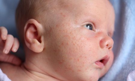 cropped IMAGE  Baby Acne or Rash  Types and How to Treat Them Baby Acne