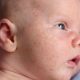 cropped IMAGE  Baby Acne or Rash  Types and How to Treat Them Baby Acne