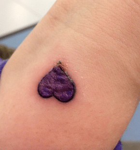 how to treat an infected tattoo