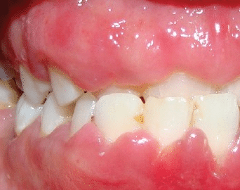 inflamed gums