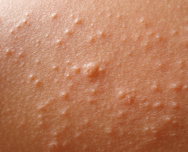 itchy white bumps on skin