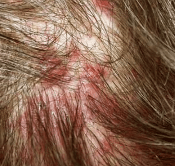 oozing blisters on scalp
