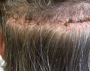 scabs on scalp