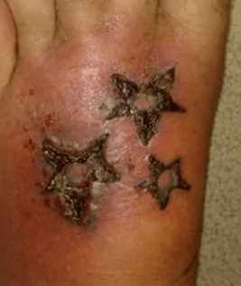infected tattoo symptoms or signs