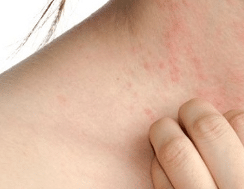 itchy bumps on skin