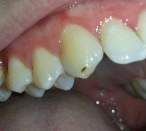 small hole in tooth