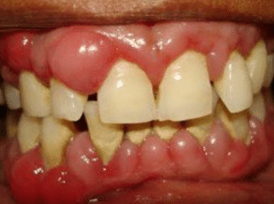 swollen gums