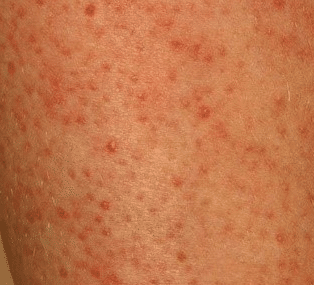 tiny red spots on skin