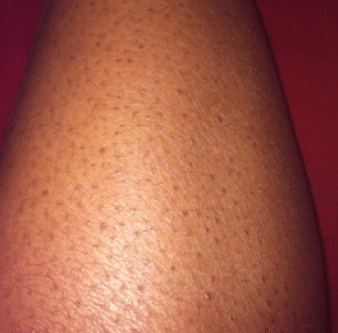 black dots on legs