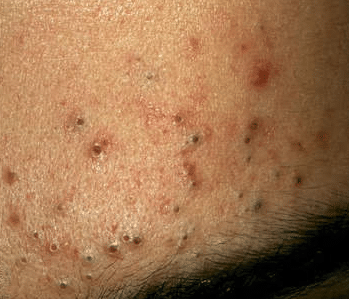 black dots on skin