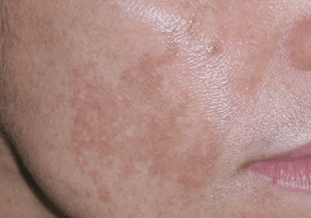 brown spots on face