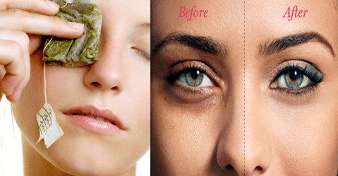 how to remove dark circles under your eyes naturally