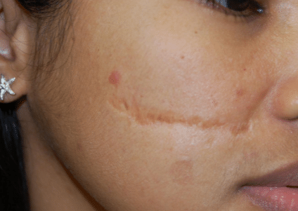 how to get rid of scars on face