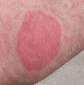 itchy circle on skin