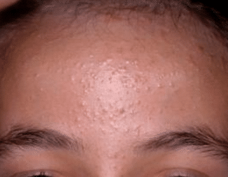 itchy forehead bumps