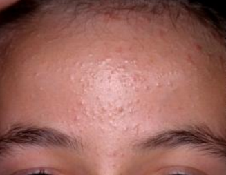 itchy forehead bumps