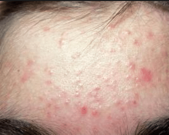 forehead red bumps