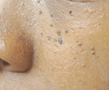 black dots on skin