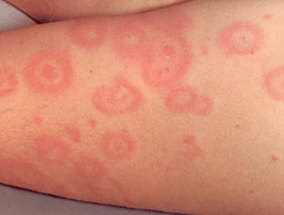 perfect red circles on skin