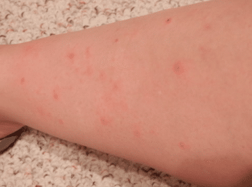 red spots on legs