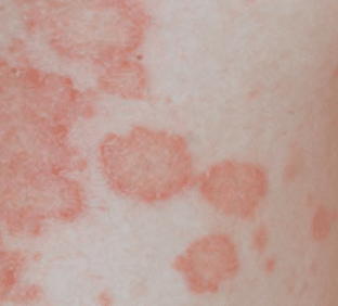 round red patches on skin