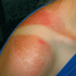 severe sunburn blisters