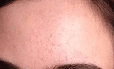 bumps on forehead